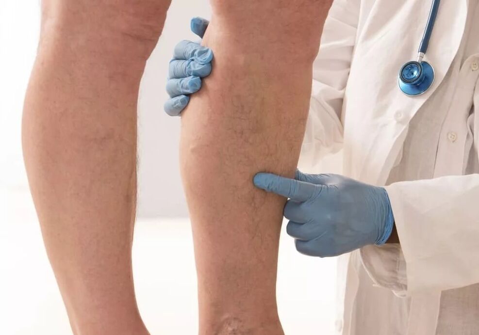 il medico esamina le gambe con vene varicose