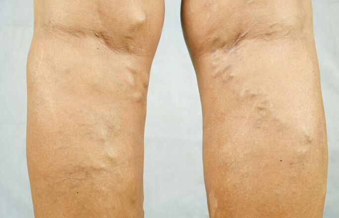 Le vene varicose alle gambe sono un motivo per consultare un flebologo