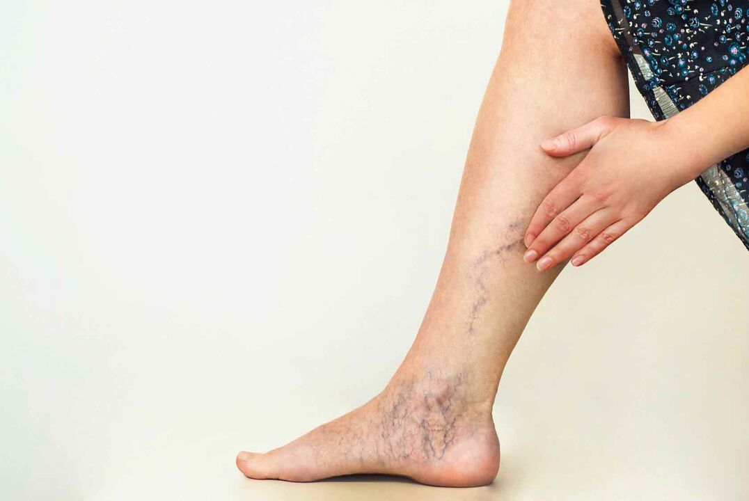 vene varicose sulle gambe delle donne