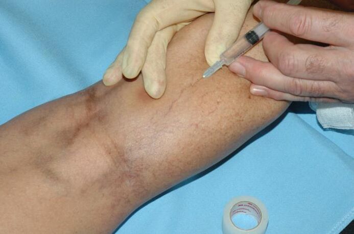 scleroterapia
