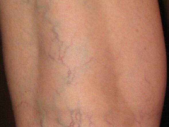Fase delle vene varicose