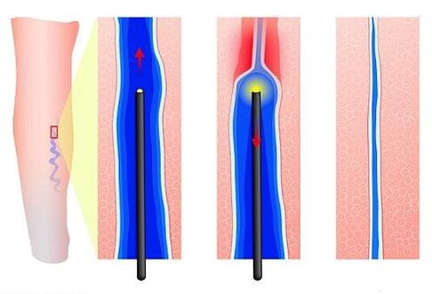 Coagulazione laser