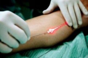 Trattamento laser delle vene varicose sulle gambe