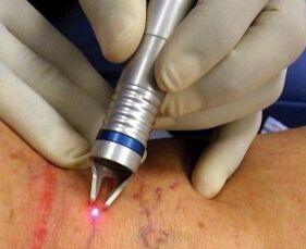 Viene effettuato il trattamento laser delle vene varicose