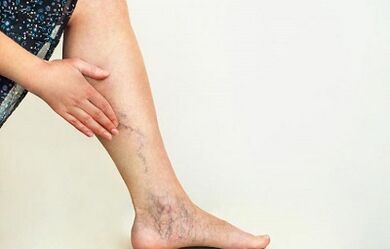 come trattare le vene varicose degli arti inferiori