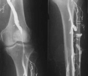 Opzioni diagnostiche per le vene varicose delle estremità