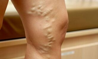 Segni e sintomi di vene varicose sulle gambe